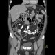 Duodenal diverticulum: CT - Computed tomography